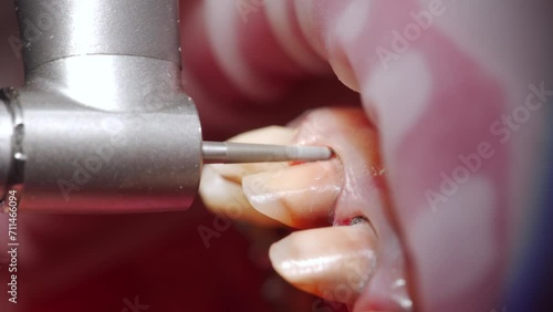 Close-up macro shot of removing tooth enamel by dental bur before installing zirconia veneers. Dentist preparing woman's teeth for the installing dental ceramic crowns. Cosmetic dentistry. photo