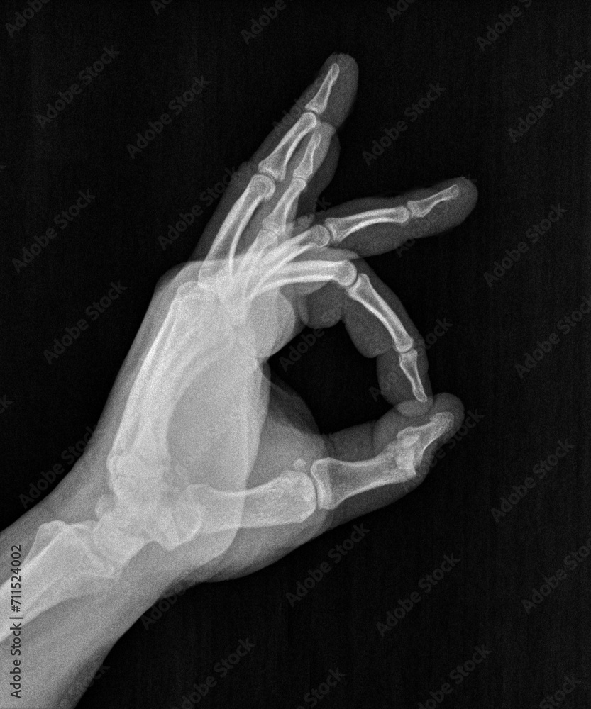 Film xray xray or radiograph of a thumb and finger circle associated