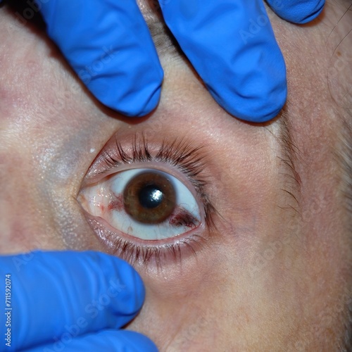 Corneal opacity or Stenon Louis sign in a corpse, forensic sciences and criminology, criminalistics, scientific police, csi