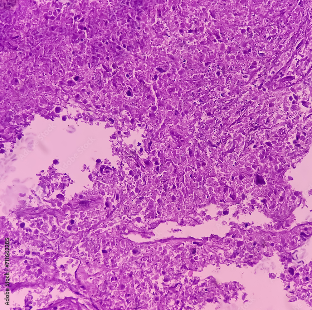 Thyroid cancer: Microscopic image of Follicular neoplasm. Malignant neoplasm of atypical thyroid follicular epithelial cells. Some of cells show pleomorphism with nuclear grooving. Nodular goiter. Thyroid cancer: Microscopic image of Follicular neoplasm. Malignant neoplasm of atypical thyroid follicular epithelial cells. Some of cells show pleomorphism with nuclear grooving. Nodular goiter.
