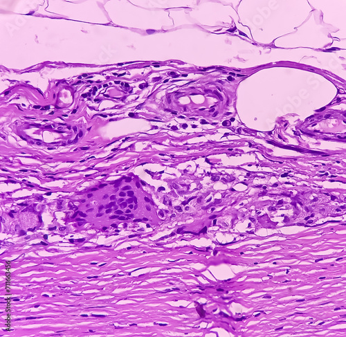Thyroid cancer: Microscopic image of Follicular neoplasm. Malignant neoplasm of atypical thyroid follicular epithelial cells. Some of cells show pleomorphism with nuclear grooving. Nodular goiter. photo