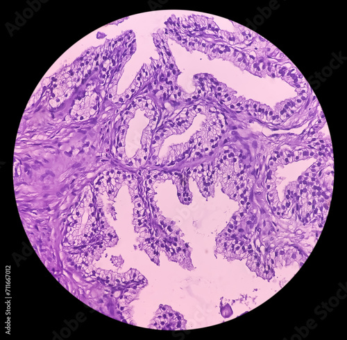 Prostatic chips (TURP): Adenocarcinoma. Sections show core of prostatic tissue. It reveals an infiltrating adenocarcinoma. Prostate cancer.