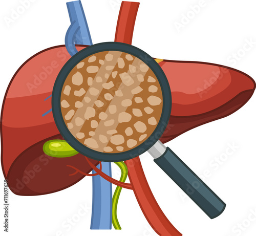 Liver disease. Cirrhosis of the Liver under a Magnifying Glass. Vector Illustration of Human Organs. Anatomy and Medicine