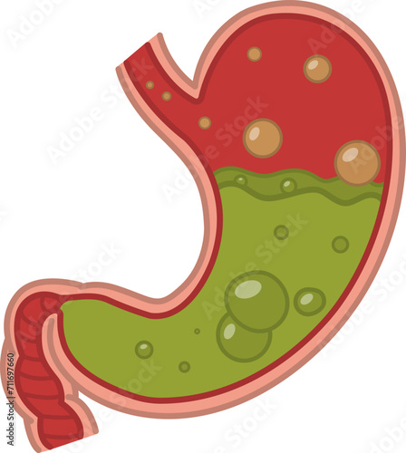 Stomach disease. The Human Stomach is Full of Stomach Acid. Nausea, Belching, Acid Reflux. Vector illustration. Anatomy and Medicine