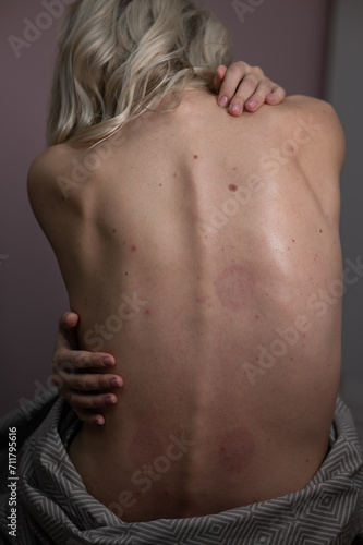 Caucasian woman after massage with vacuum cups. Vertical photo.