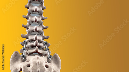 Posterior Thoracic Fusion with Pedicle Screws and Rods on Yellow Background photo