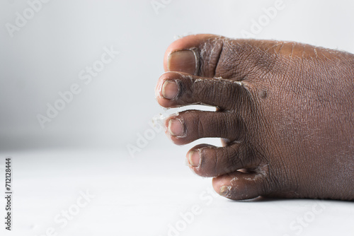Process of foot peeling, brown skin foot in the process of peeling, skin shedding on a foot photo