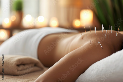 Acupuncture sessions with close-ups of the process on the body. photo