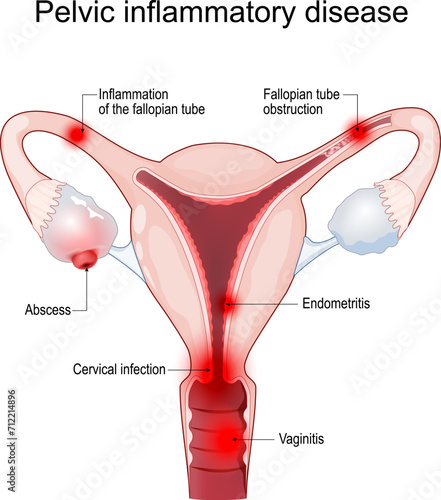 PID. Pelvic inflammatory disease