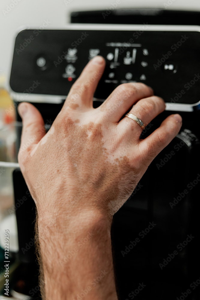 Close up of a human hand with spots of vitiligo disease operating coffee machine Close up of a human hand with spots of vitiligo disease operating coffee machine