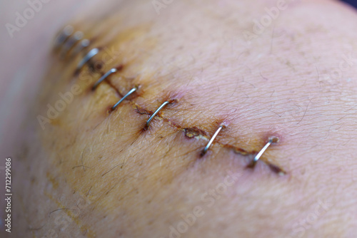 The surgical wound around the knee was sutured with staples.