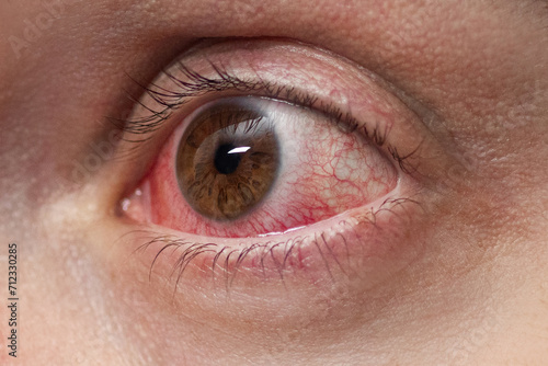 Red eye of a patient with conjunctivitis, close up photo