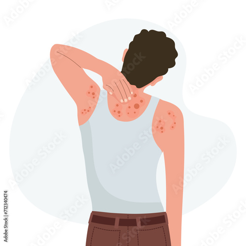 Allergic itching, skin inflammation, redness and irritation. Atopic dermatitis, eczema, psoriasis. Healthcare and medicine. Vector