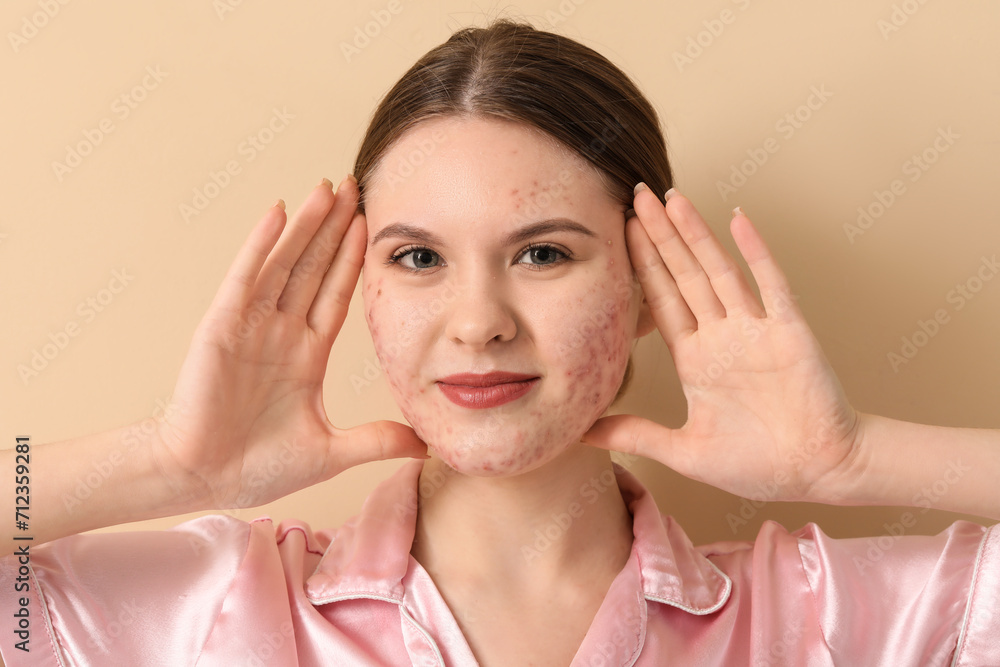 Young woman with acne problem on beige background, closeup Young woman with acne problem on beige background, closeup