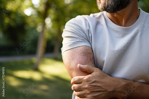 Man, joint pain and elbow arthritis in outdoor closeup in summer sunshine with massage arms. Broken arm, bone and guy at urban park in metro, city or town with physical therapy with hands in zoom  photo