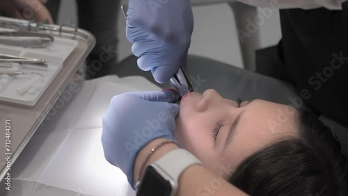 A pediatric dental surgeon loosens and removes a baby tooth with forceps under local anesthesia. The procedure of tooth extraction for a child in a dental clinic.
