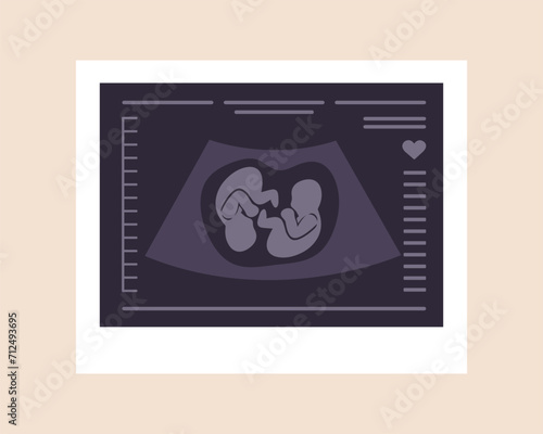 Ultrasound of twins. Embryos in womb. Pregnancy screening. Babies health diagnostic. Fetus silhouettes photo. Sonography or ultrasonography concept. Vector illustration in flat cartoon style.