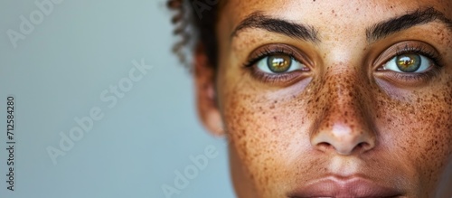 Melasma is a skin condition causing dark patches, often during pregnancy or sun exposure. photo