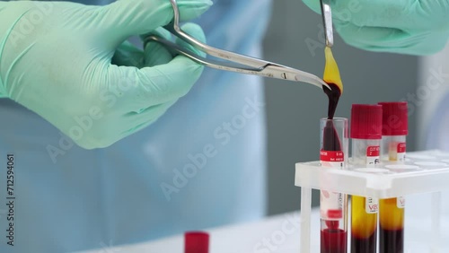 PRF platelet rich fibrin in dental surgery. Dentist's hands separate fibrin clot from lower part of centrifuged blood by surgical tweezers. PRF membrane preparation. Doctor work with fibrin. Close-up. photo