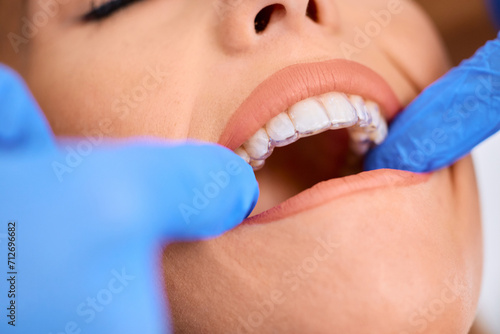 Close up of stomatologist placing invisible dental aligners on woman's teeth.