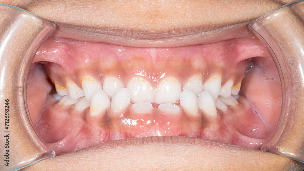Dental orthodontics case. Front view of a young girl biting teeth. Lips