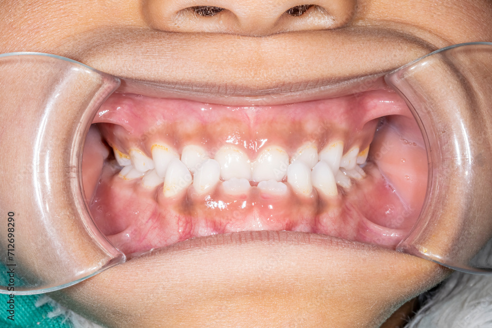 Obraz premium Dental orthodontics case. Frontal view of a young girl biting teeth. Lips retracted with cheek retractor with a skeletal Class III malocclusion, retruded maxilla or protruded mandible.