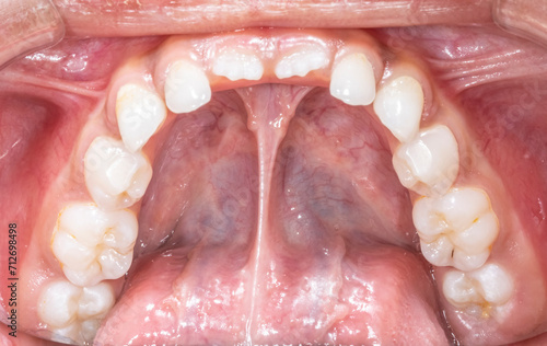 Lower mandibular arch occlusal indirect mirror view of a child milky dentition and permanent incisors erupting, teeth aligned and no decay. Gingival gum, tongue lifted with lingual frenulum.