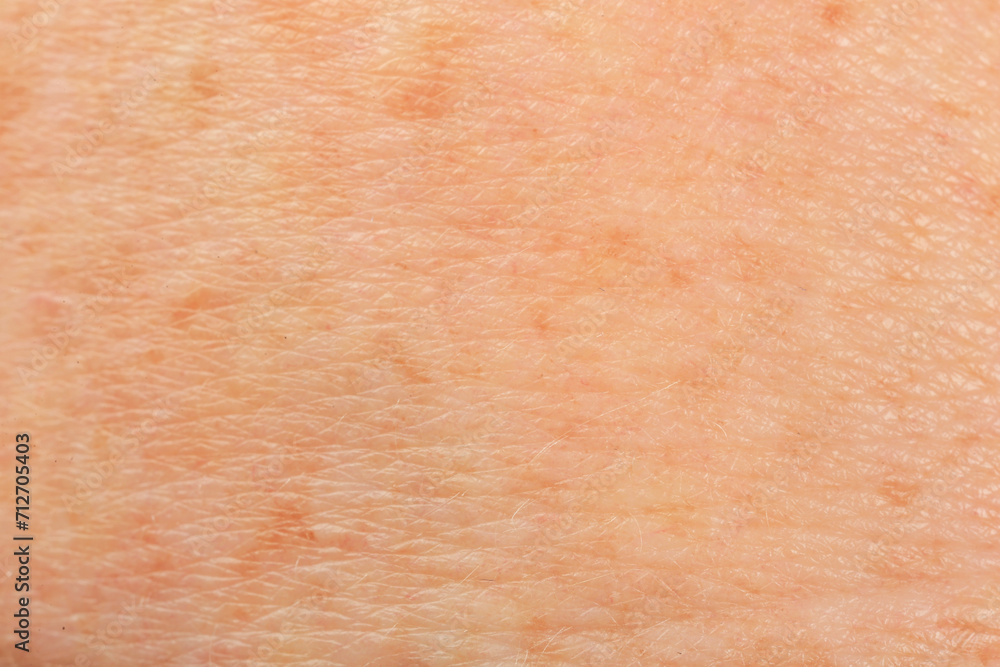 Fototapeta premium Texture of skin with pigmentation as background, macro view