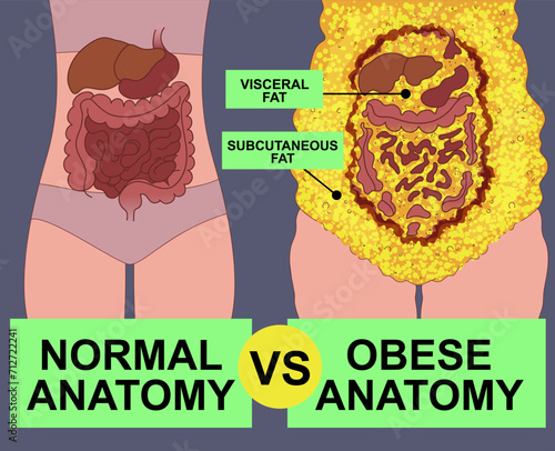 Normal anatomy vs obese anatomy. Body fat problems. Banner, snippet. Healthcare illustration. Vector illustration. 