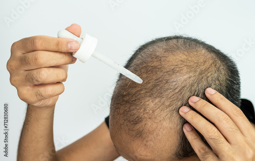 Cropped shot view of Asian baldness man using a dropper for dropping Minoxidil to his scalp. Minoxidil solution and foam are used to help hair growth in the treatment of male pattern baldness.