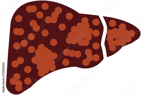 liver, cirrhosis disease. Human liver organ anatomy vector illustration on white background.Stage Of liver Disease Concept,Unhealthy Liver,Cirrhosis Medical Education,sad,red,yellow