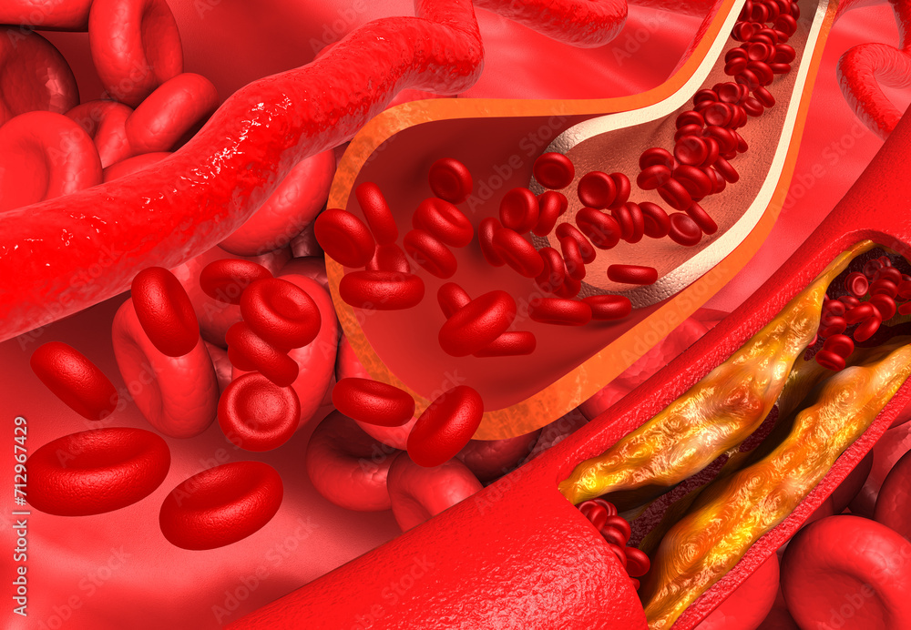Clogged heart arteries. 3d illustration.. Clogged heart arteries. 3d illustration..