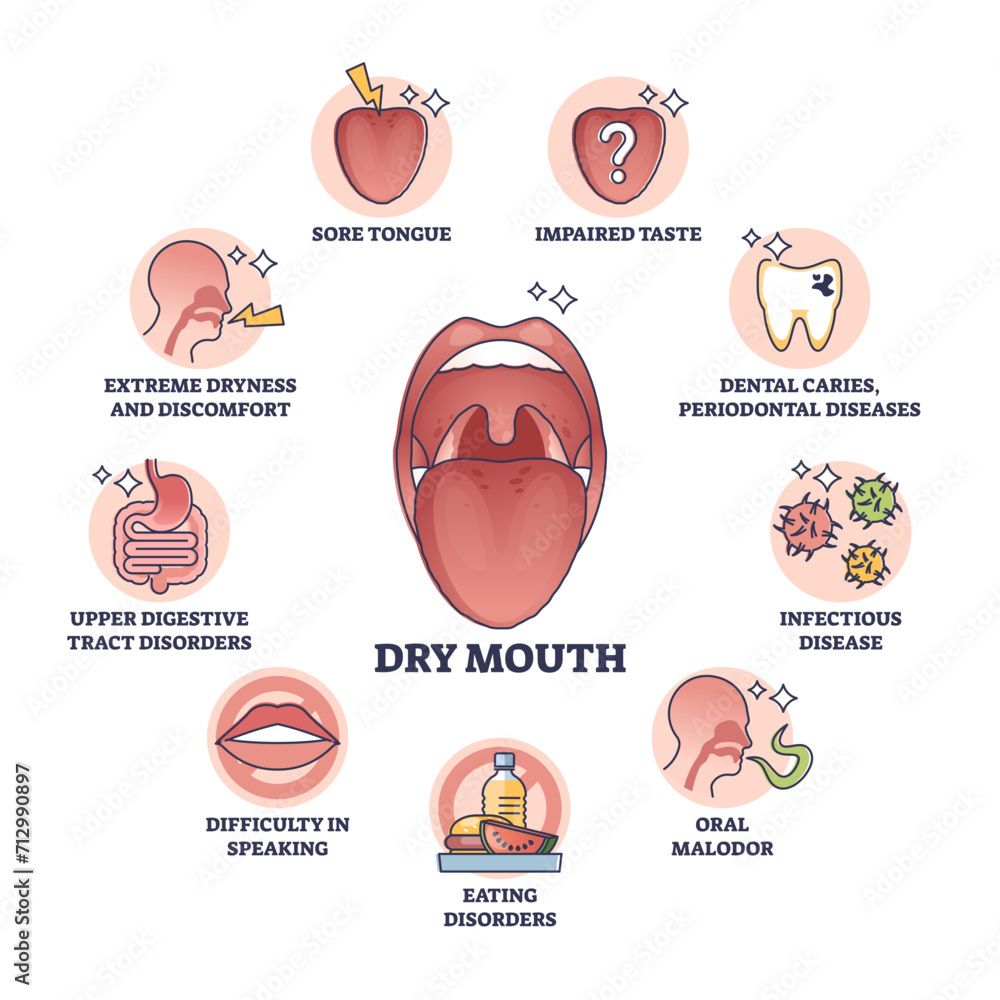 Dry mouth or xerostomia as salivary glands saliva problem outline ...