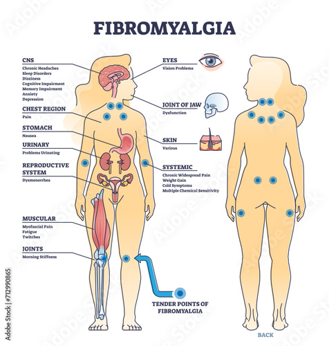 Fibromyalgia as musculoskeletal pain disorder tender points outline diagram, transparent background. Labeled educational scheme with widespread medical body problems from FMS condition illustration.