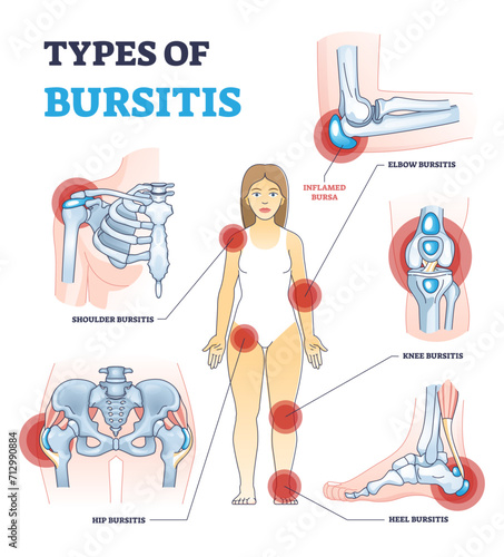 Types of bursitis as medical body joints inflammation list outline diagram, transparent background. Labeled educational painful condition examples with shoulder, hip, heel.