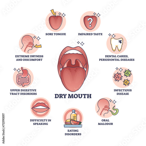 Dry mouth or xerostomia as salivary glands saliva problem outline diagram, transparent background. Labeled educational scheme with medical mouth condition, symptoms and causes illustration.