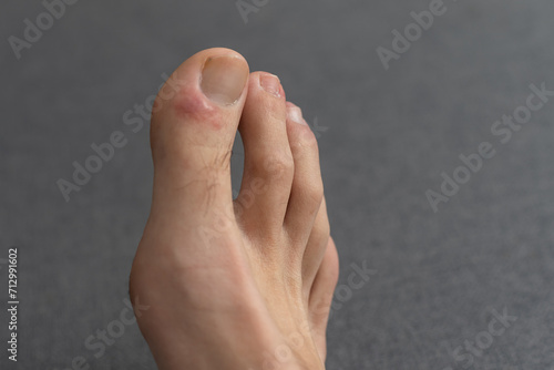 close-up of a man's toes with fungal disease, skin cracking and callus formation on his toes.