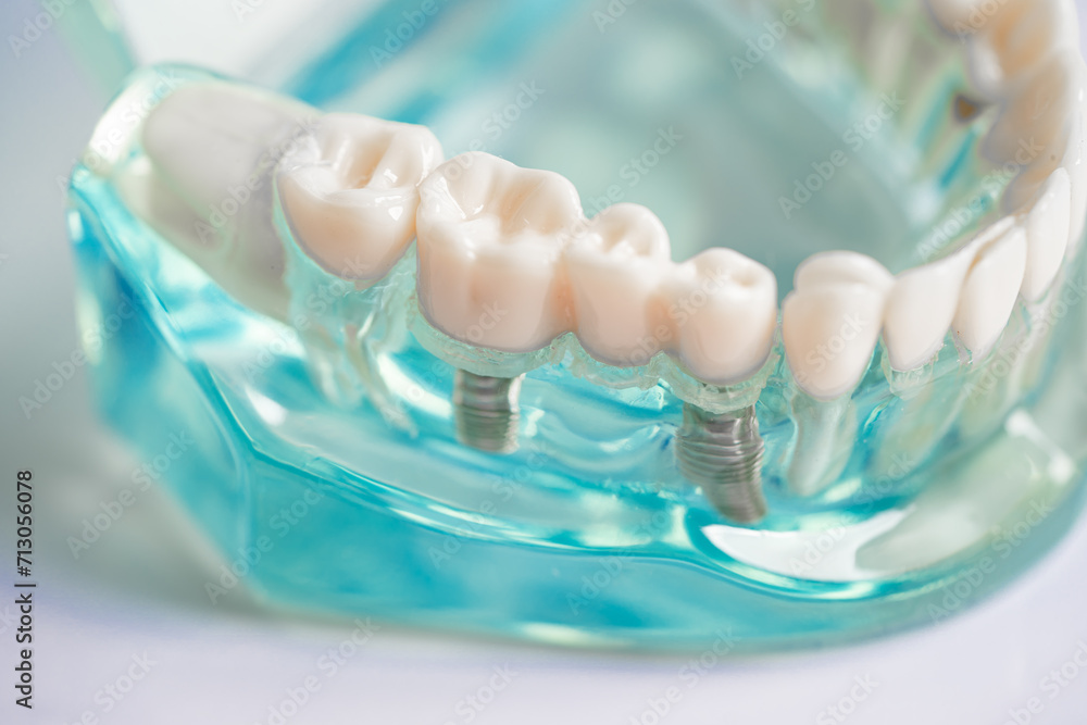 Dental implant, artificial tooth roots into jaw, root canal of dental