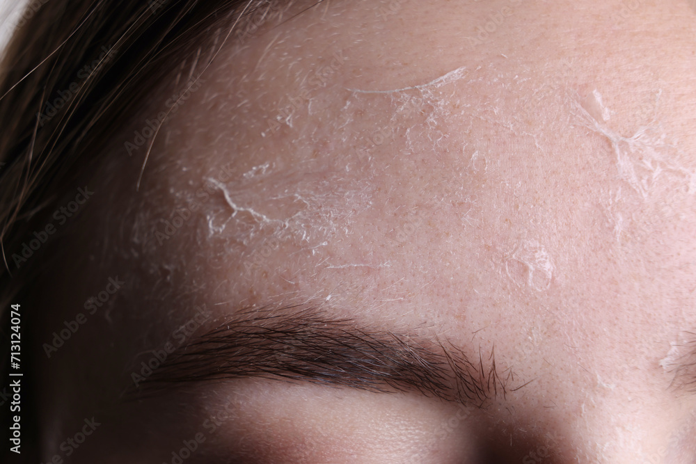 Woman with dry skin on forehead, macro view Woman with dry skin on forehead, macro view