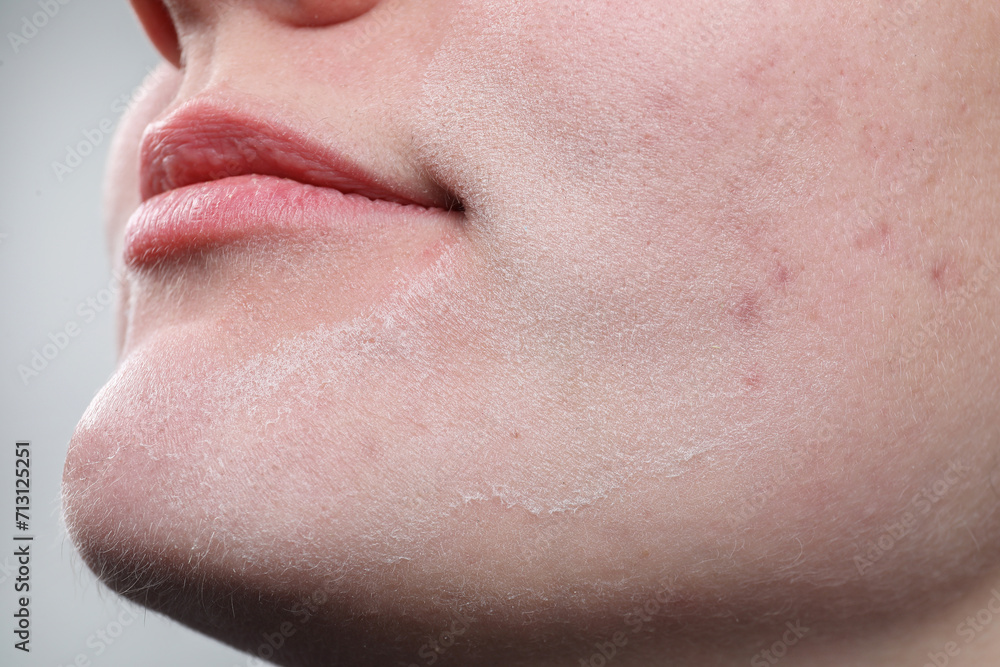 Woman with dry skin on face against light background, closeup Woman with dry skin on face against light background, closeup