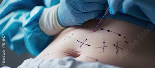 Surgeon draws correction marks on female sagging belly for plastic surgery Black surgery lines for liposuction procedure on patient fat belly close up. Copy space image. Place for adding text
