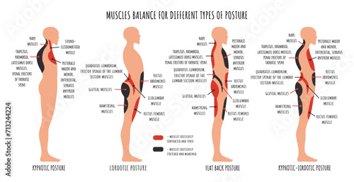 Comparison of muscle imbalance in various postural disorders. Kyphotic, lordotic, flat back posture infographics. The side view shows characteristic stretched and weakened, shortened and tens muscles