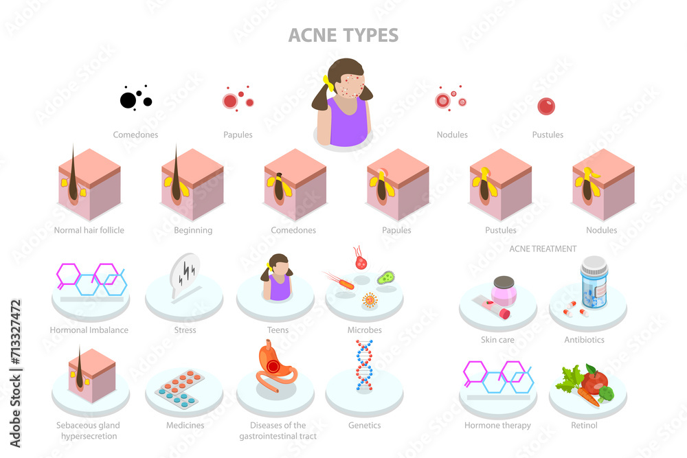 3D Isometric Flat  Conceptual Illustration of Acne Types, Skin Care