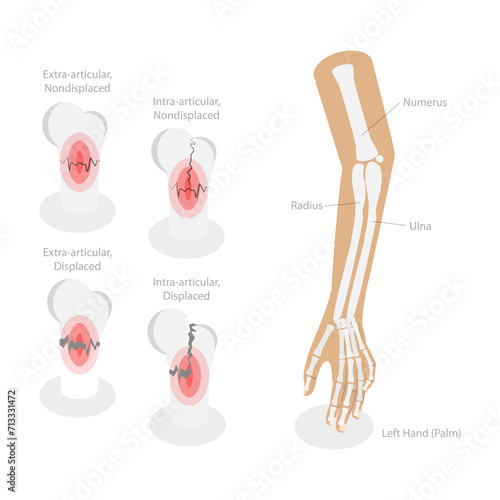 3D Isometric Flat  Conceptual Illustration of Distal Radius Fracture  Labeled Educational Diagram