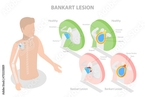 3D Isometric Flat  Conceptual Illustration of Bankart Lesion, Educational Diagram photo