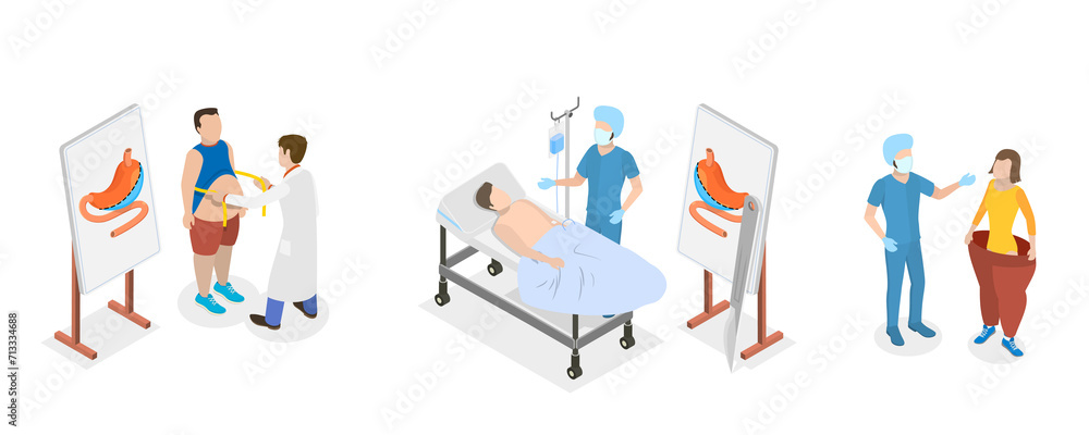 3D Isometric Flat  Conceptual Illustration of Bariatric Surgery, Vertical Sleeve Gastrectomy