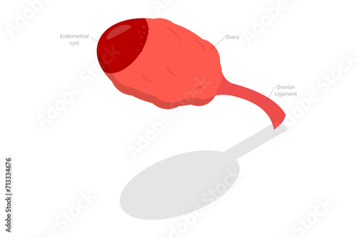 3D Isometric Flat  Conceptual Illustration of Endometrioma, Ovarian Cyst photo