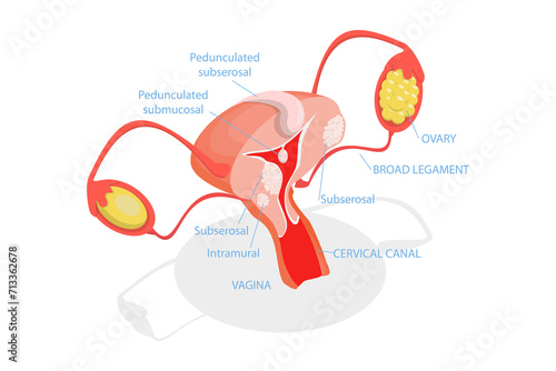 3D Isometric Flat  Conceptual Illustration of Types Of Uterine Fibroids, Human Anatomy photo