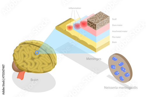 3D Isometric Flat  Conceptual Illustration of Meningitis, Human Brain and Meningococcal Bacteria photo