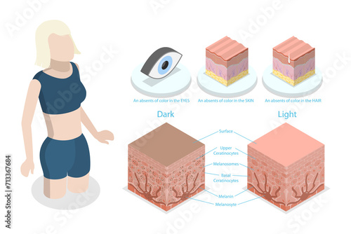 3D Isometric Flat  Conceptual Illustration of Albinism, Compared Normal Skin Cross Section with Lack of Melanocyte photo